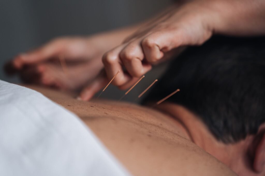 Acupuncture